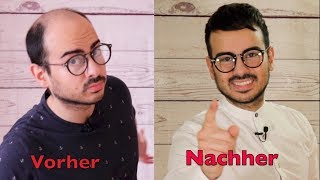 Haartransplantation Vorher Nachher 3 Monate [upl. by Elocn]