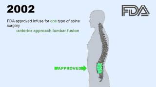 Medtronic Infuse Bone Graft Lawsuits [upl. by Ettigdirb]