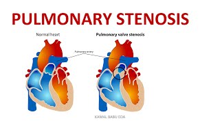 PULMONARY STENOSIS [upl. by Norha820]