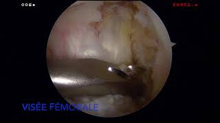 Ligamentoplastie du Ligament Croisé Antérieur LCA  Dr SIMIAN Périgueux [upl. by Corwin]