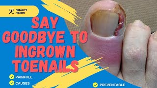 Say Goodbye to Ingrown Toenails [upl. by Salomone]