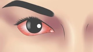 5 Remedios caseros para la conjuntivitis [upl. by Aneertak]