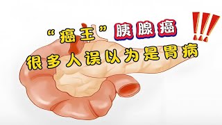 “癌王”胰腺癌，很多人误以为是胃病！出现4个症状，要多加注意 [upl. by Trebloc]