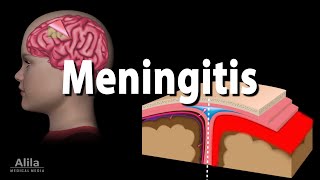 Meningitis Pathology Causes Symptoms Diagnosis and Treatment Animation [upl. by Frederik]