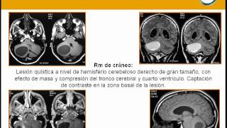 NeurorgsnetTumor quístico en cerebelo [upl. by Aniat591]