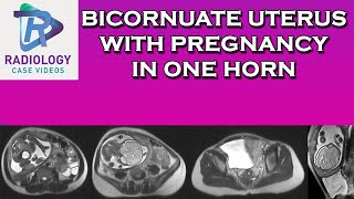 Bicornuate uterus with pregnancy in one horn [upl. by Ativad231]