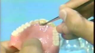 Replacing a Broken Complete Denture Tooth [upl. by Philipps]