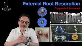 External Root Resorption EtiologyTypesTreatment الامتصاص الخارجي لجذور الاسنان  الاسباب والعلاج [upl. by Tarazi]