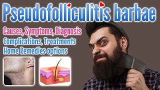 Pseudofolliculitis barbae overview causes symptoms diagnosis treatment and home remedies [upl. by Billat]