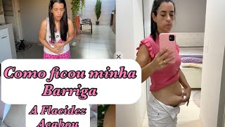 Minha Barriga antes e depois da abdominoplastia Fui ao Médico [upl. by Joete]