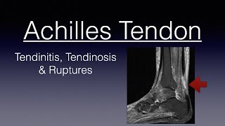 ACHILLES TENDINITIS AND RUPTURES and everything in between tendinosis  Achilles Tendon  Tears [upl. by Kessiah257]