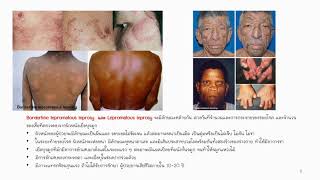 โรคเรื้อน Leprosy [upl. by Bassett]