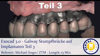 2021 Exocad Tutorial 30  Galway Stumpfbrücke auf Implantaten amp Mundscan Teil 3 [upl. by Aloysia]