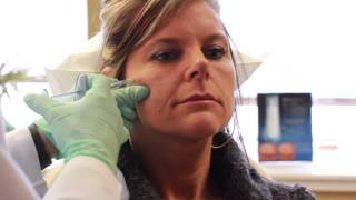 Juvederm Voluma XC Demonstration [upl. by Hannahc]