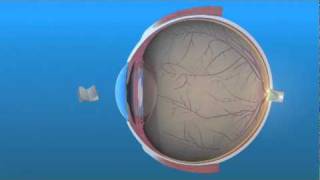 Intraocular Lens IOL [upl. by Portuna]