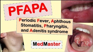 PFAPA Syndrome Periodic fever Aphtous stomatitis Pharyngitis Adenitis [upl. by Nnalyrehc]