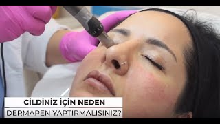 CİLDİNİZ İÇİN NEDEN DERMAPEN YAPTIRMALISINIZ [upl. by Stanfill]