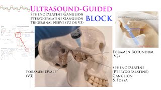 UltrasoundGuided Sphenopalatine Pterygopalatine Trigeminal Nerve Gasserian Ganglion Blocks [upl. by Adnamra]