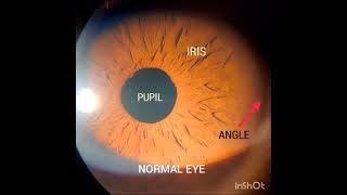 Laser Peripheral Iridotomy for Angle closure glaucoma [upl. by Lyndsey]