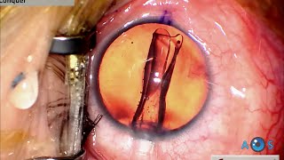 Visian ICL EVO Toric for High Myopic Astigmatism Lens Loading and Surgical Technique Guide [upl. by Reivaz]