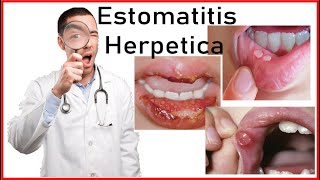 Estomatitis Herpetica y Herpes Simple  Etiologia Signos SintomasTratamiento Diagnostico VSH1 [upl. by Sirdi]