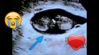 Baby diagnosed DEAD at 8 12 weeks pregnant via Ultrasound Miscarriage DampC Needed [upl. by Emerick]