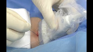 Brachial artery line insertion [upl. by Osborn]