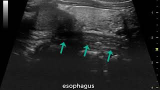 Esophagus in real time ultrasound [upl. by Varick695]