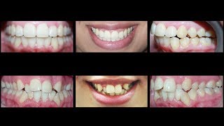 Invisalign for Treating Crowding Teeth and Crossbite at Cosmetic Dental Associates [upl. by Maidy]