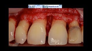 Periodontal Surgery Upper Front Teeth [upl. by Adnofal384]