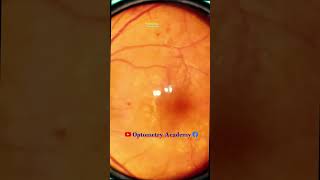 Diabetic retinopathy  Dot Hemorrhages  Hard exudates  Fundus  Short Video 175 [upl. by Crispas186]