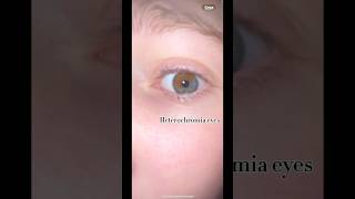 I have heterochromia ￼ [upl. by Adias]