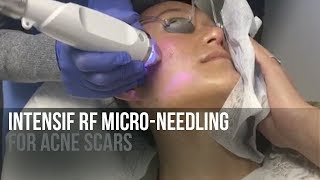 Intensif RF Microneedling For Acne Scars  LIVE [upl. by Seroled]