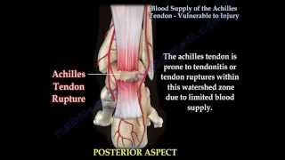 Achilles Tendon rupture  Vulnerablity to Injury  Everything You Need To Know  Dr Nabil Ebraheim [upl. by Ahsiek]