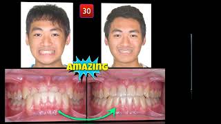 Solving Class III Malocclusion with Anterior Xbite｜【Chris Chang Ortho】CC655 [upl. by Franzen548]