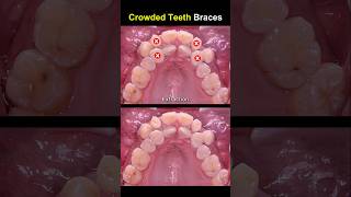 Complex braces for crowded teeth braces orthodontist dentist [upl. by Jesselyn]