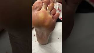 Watch as our Aussie podiatrist says Gday to corns amp calluses 👣🇦🇺 Podiatry FootCare [upl. by Agna860]