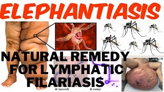 HOW TO TREAT LYMPHATIC FILARIASIS ELEPHATIASIS AND THE BEST NATURAL HOME REMEDY FOR TREATMENT [upl. by Neilla]