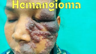 Vascular malformation Hemangioma  Planning of treatment Hemangioma treatment in Ranchi [upl. by Sladen]