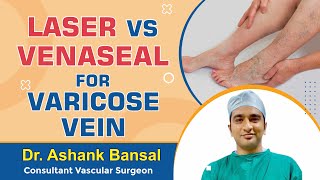 Laser Vs Venaseal for Varicose Vein  Dr Ashank Bansal [upl. by Anwat]