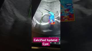 Calcified hydatid cyst ultrasonography radiology imagine hepatic bass remix music [upl. by Ban]