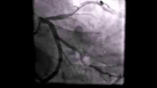 Coronary artery thrombus [upl. by Yunick406]