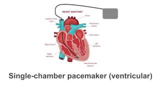 Pacemaker Varieties Single to Biventricular Explained [upl. by Stephan]