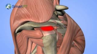 Shoulder Impingement [upl. by Zaslow]