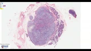 Salivary gland Pleomorphic adenoma Microscopy  Talking slide [upl. by Almire]