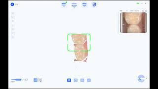 Intraoral Scanner Clinical Real Scan Case Children [upl. by Chaker]