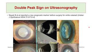 Perioperative Assessment of Intumescent Cataract How to Prevent Argentinian Flag Sign [upl. by Atiuqihc]