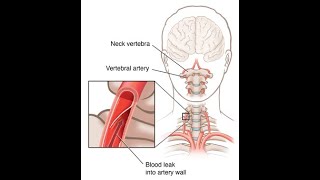 Applied or clinical anatomy of vertebral artery  Occlusion to branches of vertebral artery [upl. by Pellet]