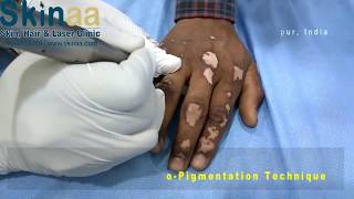 Vitiligo or Leucoderma Treatment Micropigmentation in India  Safed Daag Ka Ilaj │Skinaa Clinic [upl. by Basia]