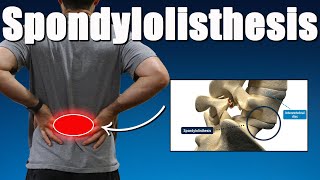 Lumbar Spondylolisthesis Best Exercises Rehab Advice amp Myth Busting for Back Pain Relief [upl. by Ruosnam]